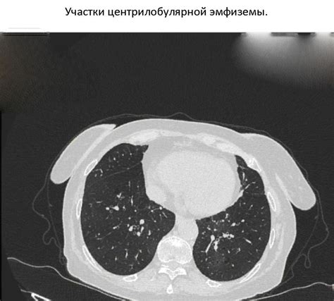 Центрилобулярная эмфизема легких: