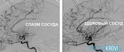 Церебральная ангиодистония по гипертоническому типу у ребенка