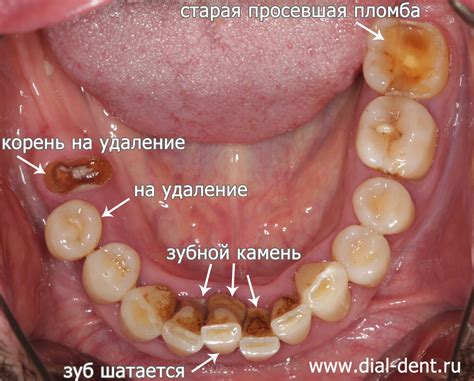 Что делать, если выпал передний зуб сверху без неприятных ощущений?