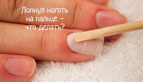 Что делать, если ноготь лопнул?