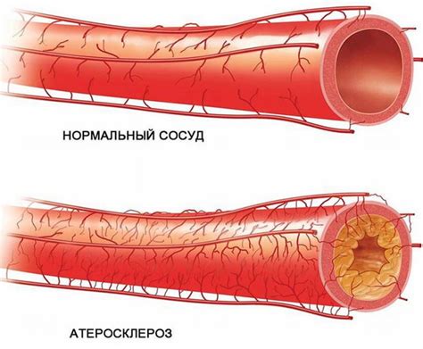 Что значит, если сосуды инъецированы