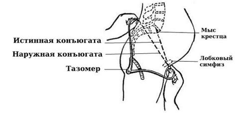 Что значит разошелся таз: причины, симптомы и методы лечения