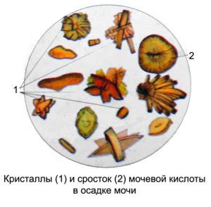 Что значит соли мочевой кислоты?