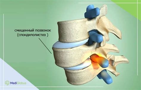 Что может произойти при нелеченом смещении позвоночника?