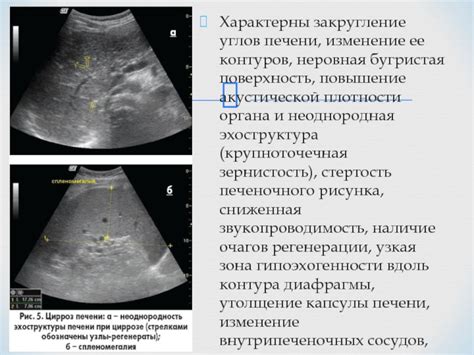 Что означает закругление углов печени и почему это важно для здоровья?