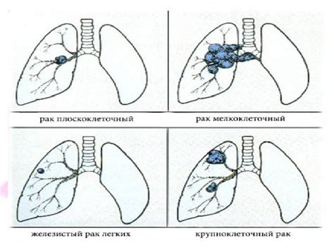 Что означает категория сложности 5 в онкологии?