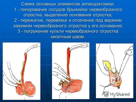 Что означает лигирование сосудов?