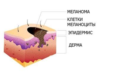 Что означает отсутствие родимого пятна?