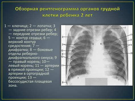 Что означает сокращение синусов на флюорографии?