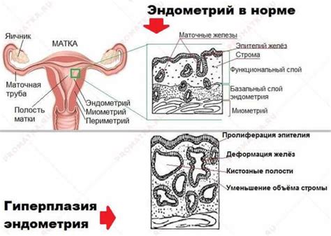 Что означает толстый эндометрий?