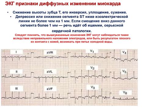 Что означают незначительные изменения миокарда в ЭКГ?