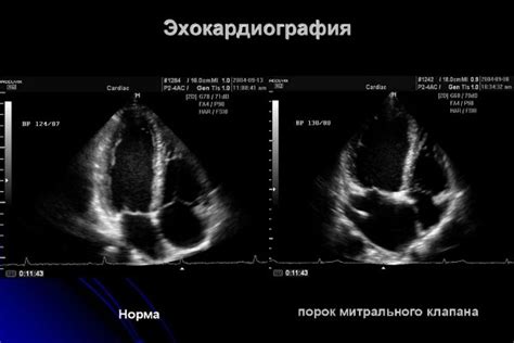 Что показывает результат нормальной эхограммы?