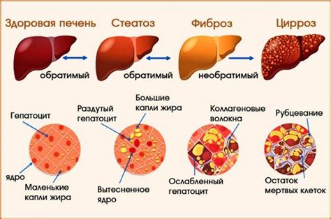 Что приводит к сильному увеличению печени?