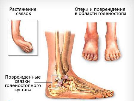 Что становится причиной роста кости на ноге?