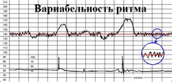 Что такое КТГ и вариабельность КТГ