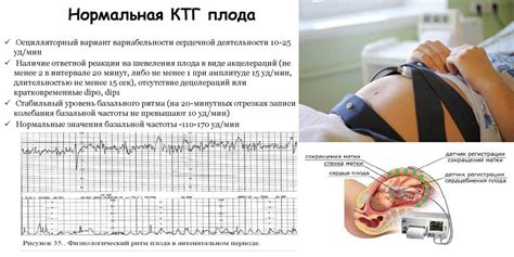 Что такое КТГ и как он работает?