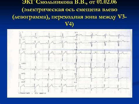 Что такое ЭКГ и как она помогает обнаружить блокаду