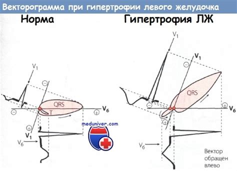 Что такое ЭКГ признаки ГЛЖ?