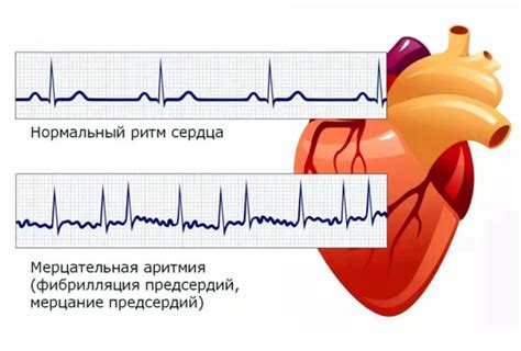 Что такое ЭКГ ритм предсердный?