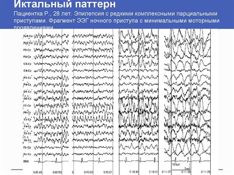 Что такое ЭЭГ вариант нормы?