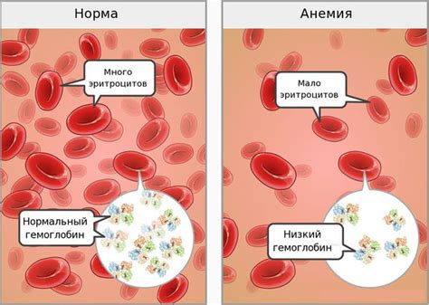 Что такое анемия и ее связь с недостатком железа