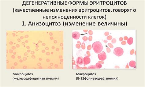 Что такое анизоцитоз?