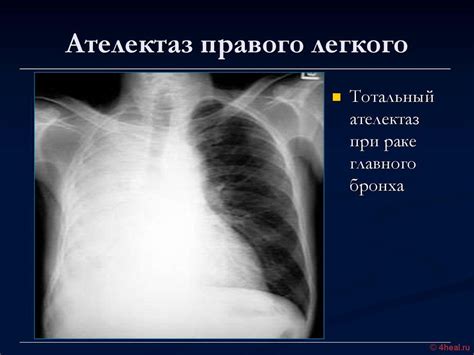 Что такое ателектаз легких?