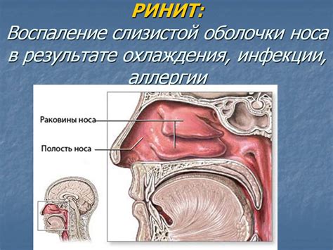 Что такое атрофический ринит?