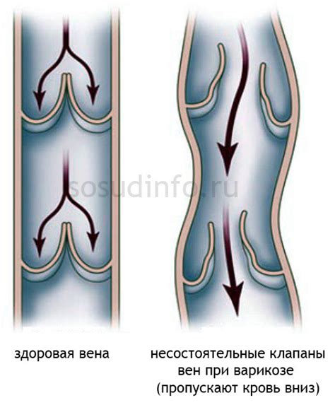 Что такое венозный стаз?