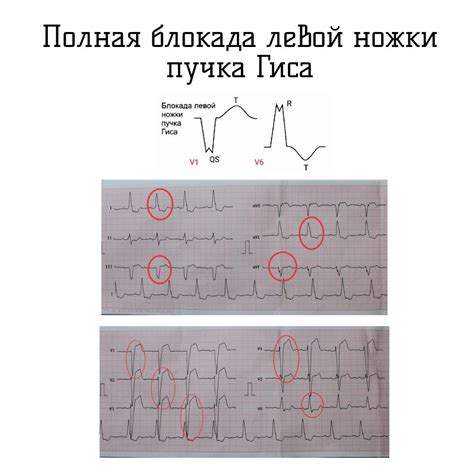 Что такое вертикальная неполная блокада: