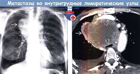 Что такое визуализация регионарных лимфоузлов