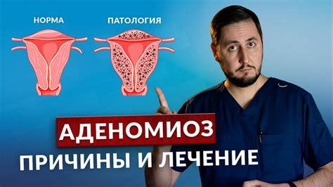 Что такое внутренний аденомиоз матки?