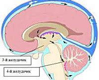 Что такое внутренняя окклюзионная гидроцефалия?