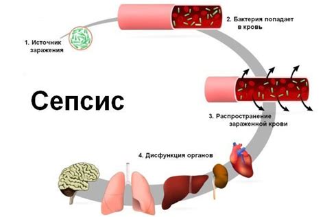 Что такое внутрибольничный сепсис?