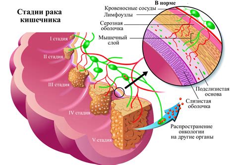 Что такое водянистая опухоль