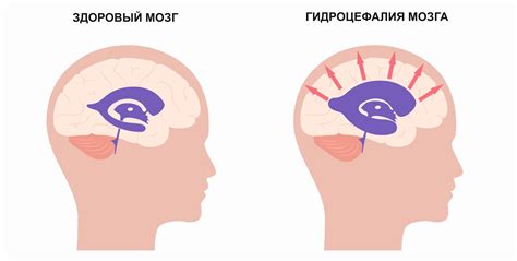 Что такое водянка головного мозга?