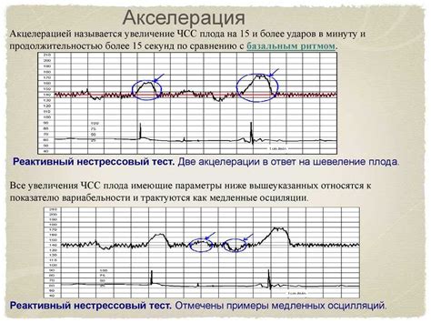 Что такое волны КТГ