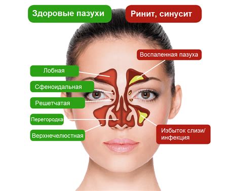 Что такое гайморит и какую роль играет пункция в его лечении?