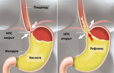 Что такое гастроэзофагальный рефлюкс и как с ним бороться?