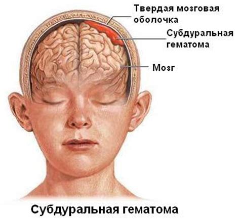 Что такое гематома головы?