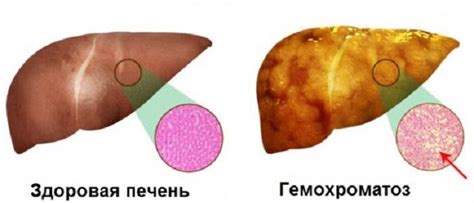 Что такое гемохроматоз и его причины