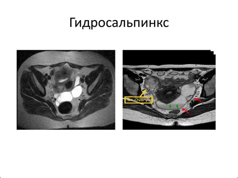 Что такое гидросальпинкс?