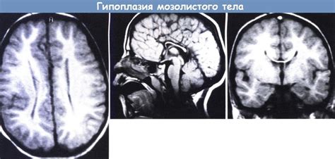 Что такое гипогенезия мозолистого тела