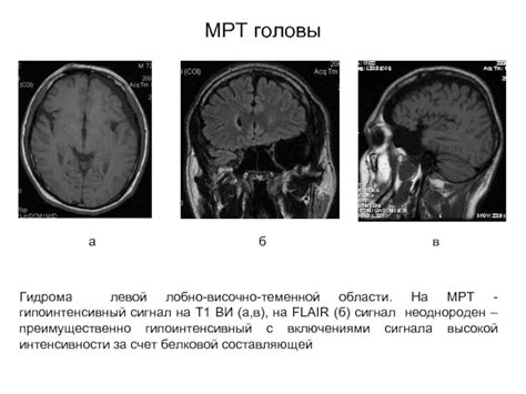 Что такое гипоинтенсивный сигнал МРТ?