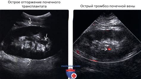 Что такое гипотензивное образование в почке?