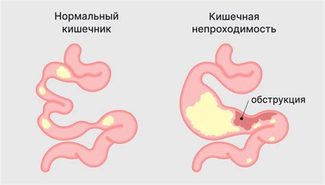 Что такое гипотонический колит кишечника?