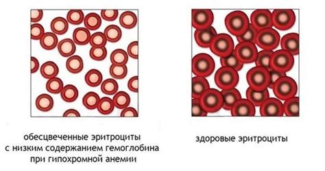 Что такое гипохромная анемия у детей: