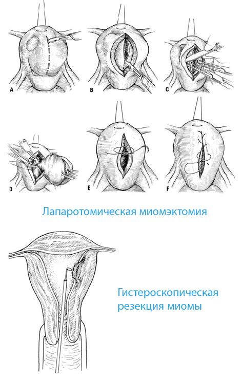 Что такое гистерорезектоскопическая миомэктомия?