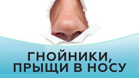 Что такое гнойнички на носу?