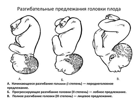 Что такое головное предлежание?